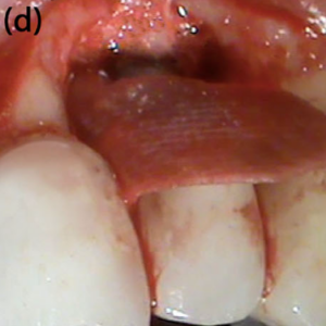 Verwendung von  OS+Tobra und OS+Vanco